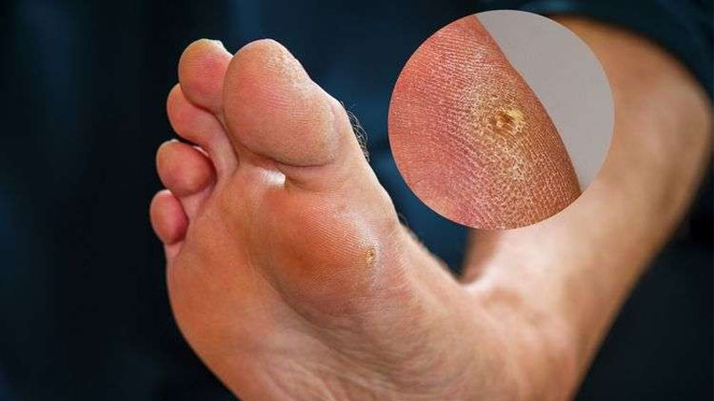 Kaki Kapalan dan Pecah-Pecah: Lebih dari Sekadar Estetika, Kenali Implikasinya – PAFI Sendawar